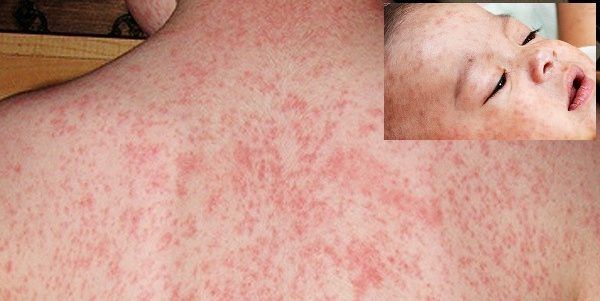 হাম ভাইরাস সংক্রমণে সিলেটে শিশুর মৃত্যু - Banglar Mati